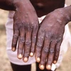 Singapore detects first case of rare monkeypox