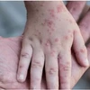 Thailand confirms first female monkeypox case 