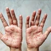 Laos detects first monkeypox case 