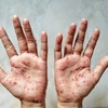 Cambodia logs 12 cases of monkeypox