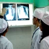 Vietnam con el mayor número de pacientes con aspergilosis en el mundo