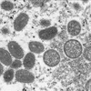 Vietnam detecta primer caso de viruela símica