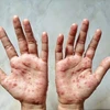 Camboya registra 12 casos de viruela símica