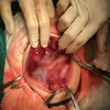 Intervention chirurgicale satisfaisante sur un fœtus in fœtu à l’hôpital pédiatrique Nhi dông 2