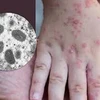 Le Vietnam a maîtrisé son premier cas de monkeypox