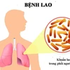 Ежегодно во Вьетнаме выявляется более 100 000 больных туберкулезом, при этом показатель успешности лечения превышает 90%.(Фото: plo.vn)