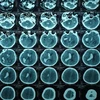 九龙江平原首次通过脑室外引流新技术成功治愈一例脑出血患者
