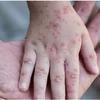 越南需准备好应对猴痘疫情的方案