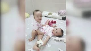 HCM City doctors separate conjoined twins