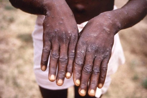 Singapore detects first case of rare monkeypox