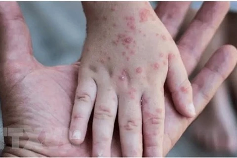 Thailand confirms first female monkeypox case 