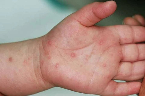 Large amount of hand-foot-mouth disease treatment drug provided to hospitals