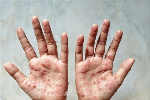 Laos detects first monkeypox case 