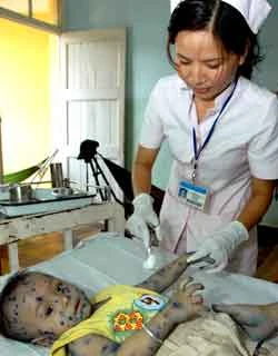 A doctor treats a boy with chicken-pox at Paediatrics Hospital No2 in HCM City (Photo: The Anh/ VNA) 