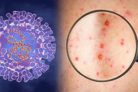 Ministerio de Salud traza plan de respuesta a posible invasión de viruela símica