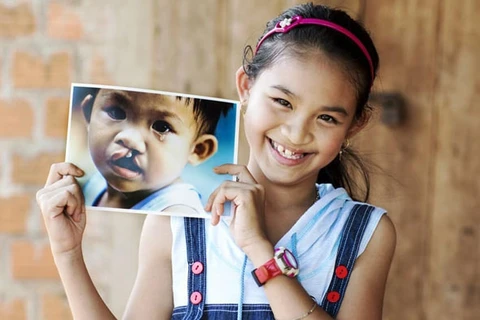 Operation Smile Vietnam rendra le sourire à 200 enfants en mars