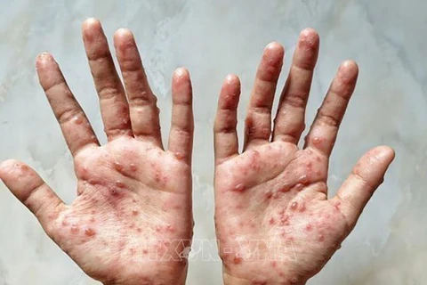 Le ministère de la Santé recommande des mesures préventives contre la variole du singe
