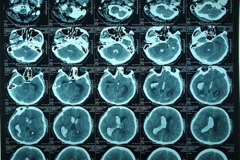 九龙江平原首次通过脑室外引流新技术成功治愈一例脑出血患者