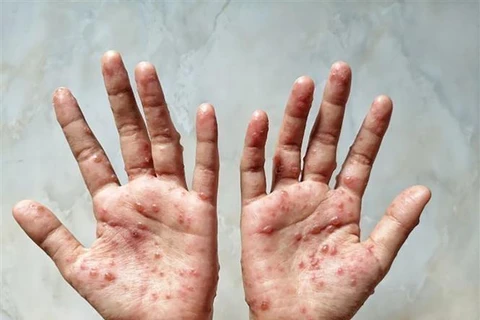 柬埔寨猴痘病例呈增加趋势