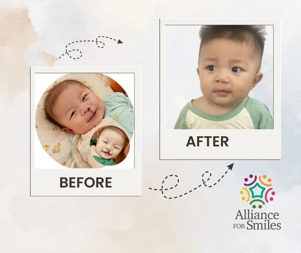 The third “Light up Vietnam’s smile” programme to provide free surgery for disadvantaged people with cleft lips and palates is open for registration until October 30. (Photo courtesy of AFS)