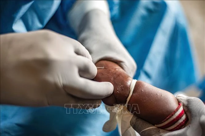 Healthcare workers are treating a young child infected with mpox in Nyiragongo, North Kivu, Democratic Republic of the Congo, on August 15, 2024. (Photo: Xinhua/VNA)